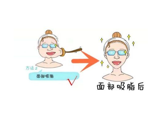 武汉协和脸部吸脂手术口碑如何？王海平医生资料+案例反馈