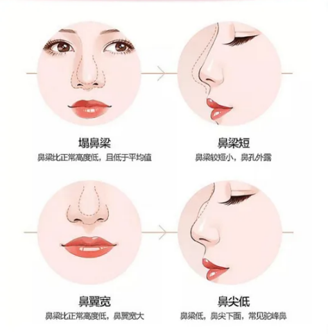 金尔丽整形医院假体隆鼻，项目价格表及简介一览