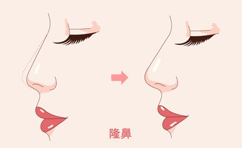 佛山整鼻子需要多少钱?三家热门医院值得一试