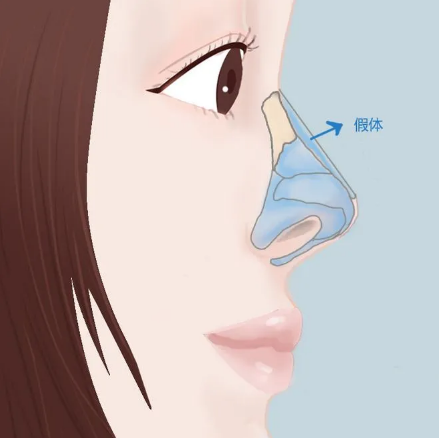 莫娜丽莎的玻尿酸多少钱一支？