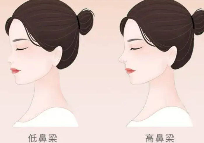 北京协和医院整形科隆鼻案例分享展示，附上图