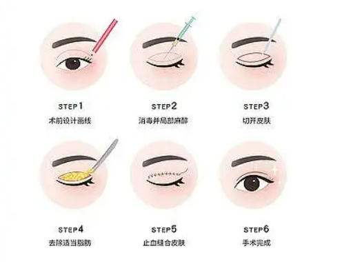 割双眼皮类型有哪些？具体要怎么操作？