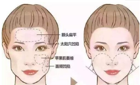 南京华美整形医院自体脂肪丰太阳穴整形案例分享，实力医院推荐