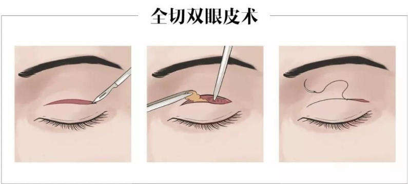 北京八大处割双眼皮怎么样？实力医院技术信息在线浏览