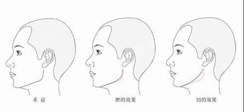 长沙晶肤医疗美容医院颧骨整形手术技术好不好？费用价格多少？真人反馈怎么样？