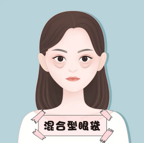 泰州做眼袋手术多少钱?靠谱整形医院满足你的去眼袋需求