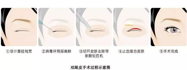 淮南东方医院集团谢一医院整形科全切双眼皮贵吗？科室介绍以及案例真实叙述