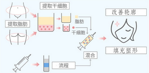 深圳美莱医疗美容医院做脂肪填充好吗？人气医生扎堆真的可以冲
