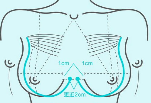 泉州二院美容整形科隆胸多少钱？效果好不好？附案例展示