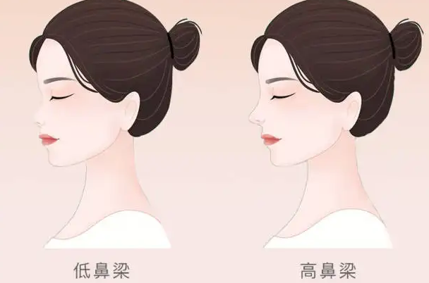 隆鼻怕术后恢复不好？护理知识一览