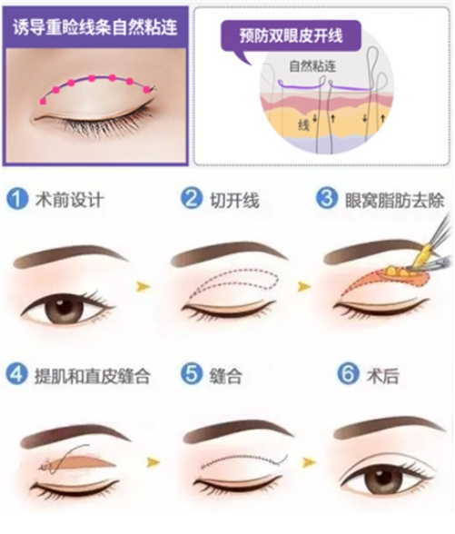江南大学附属医院双眼皮修复贵吗？指南分享|沉浸式体验做双眼皮