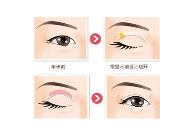 北京八大处全切双眼皮多少钱？实力医生推荐|灵动双眼皮案例反馈