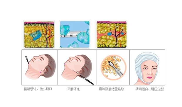 安徽省红十字会医院整形科面部吸脂怎么样？医院详细资料+新鲜案例参考