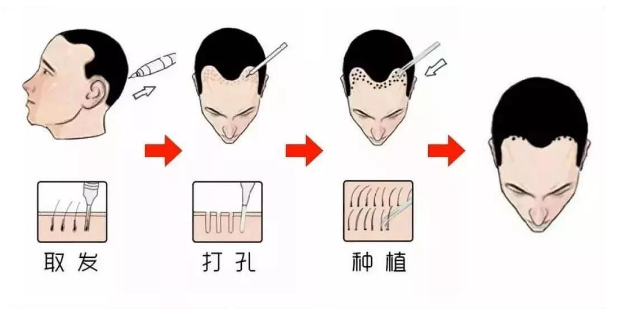 种植发际线多少钱一个毛囊？植发前必看攻略更新附案例