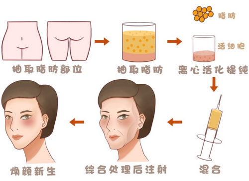 成都艾米丽脂肪填充怎么样？医院介绍/术后恢复过程大揭秘