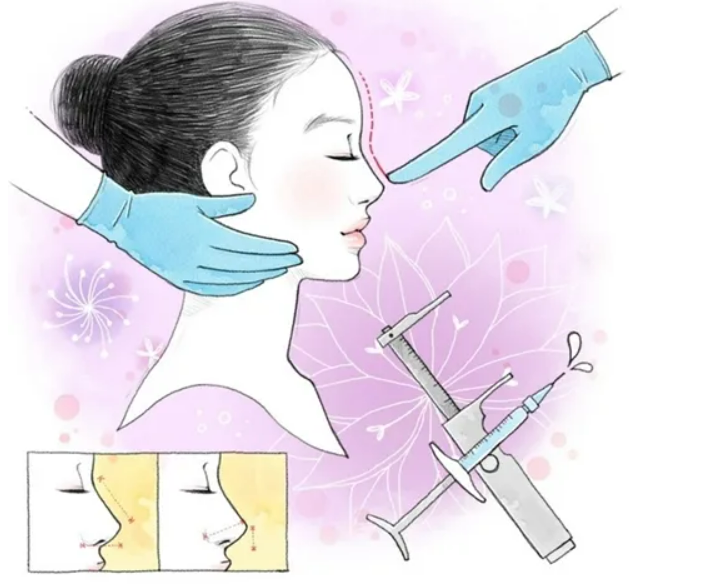 隆鼻手术能维持多久？术后如何快速消肿？我们一起来看看
