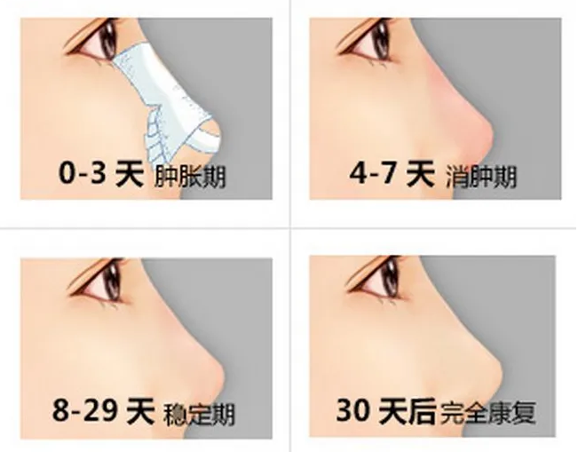 滨医附院整形科隆鼻真人案例分享，内附医院信息