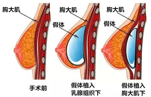 武汉市第一医院美容科硅胶隆胸怎么样？医生技术能力强+效果自然