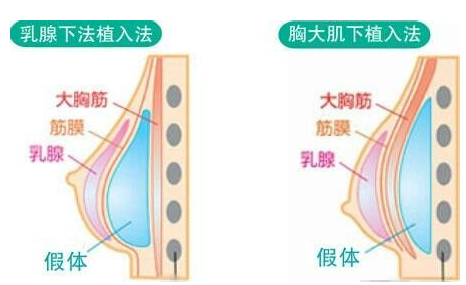 江西省皮肤病专科医院医学美容假体隆胸好不好？医院手术价格表+医院介绍一览