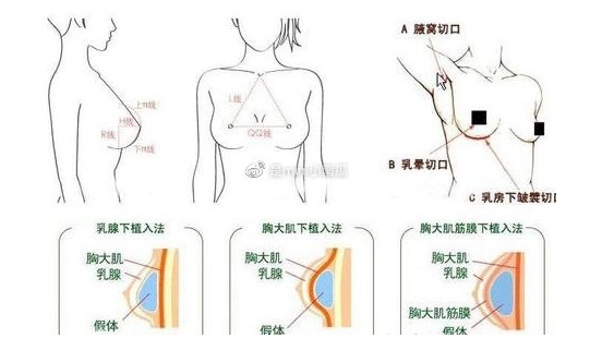 桂林医学院附属医院整形科硅胶隆胸介绍及项目收费标准分享 +医院简介