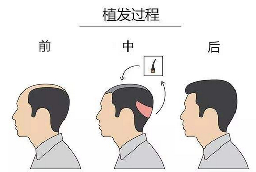 中山植发手术需要多少钱?头发种植医生综合实力前3介绍
