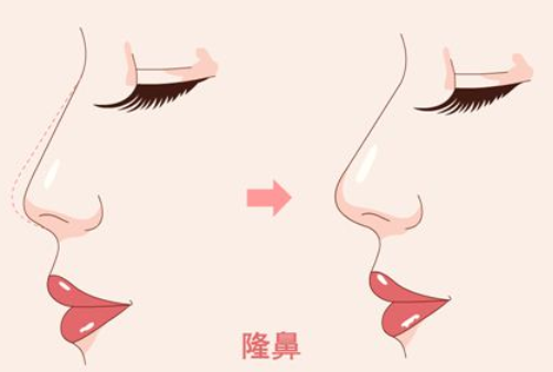 广州美恩整形医院隆鼻多少钱？医院简介|术后反馈