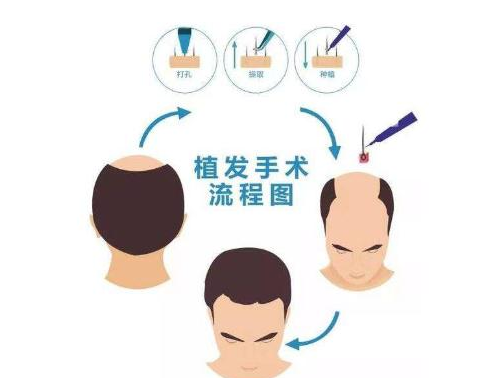 广州碧莲盛植发医院怎么样?费用参考及头发种植案例