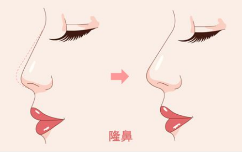 武汉协和医院整形外科隆鼻多少钱？医院案例信息汇总