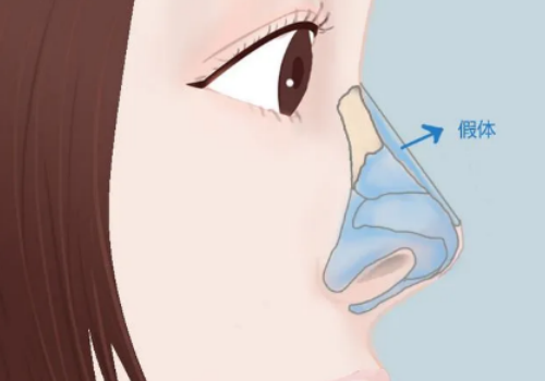 北京晶美整形医院隆鼻怎么样？术后果反馈及费用