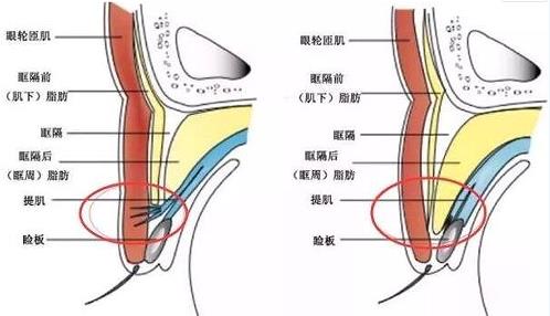 南宁美丽焦点美容医院评价好吗？双眼皮案例及收费标准参考