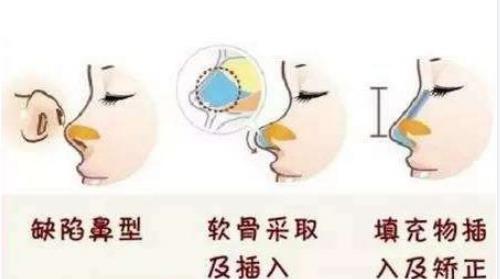 南阳薇美医疗整形医院隆鼻价格|医院信息及案例口碑细节展示