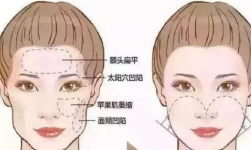 上海鹏爱医疗美容门诊部玻尿酸除皱多少钱？体验感受及医院实力详解
