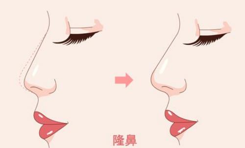 济南诺德医院隆鼻怎么样？案例反馈及费用标准发布