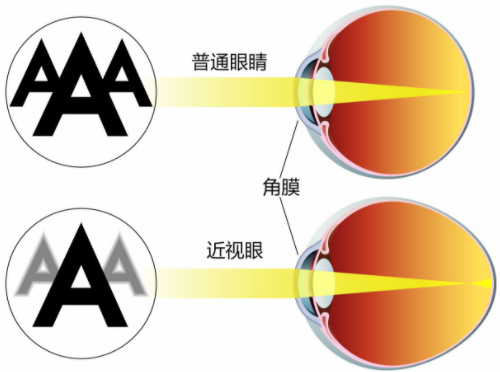 贵州晶朗眼科医院眼科怎么样？近视手术案例分享+相关问答