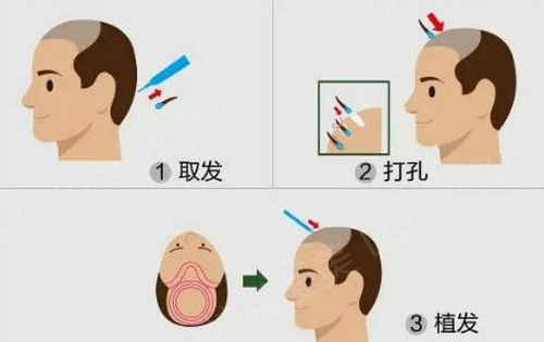 北京协和医院植发科怎么样？价格表及坐诊专家医生简介一览