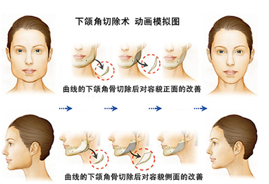 南方医院整形科下颌角价格多少？医院规模怎么样？