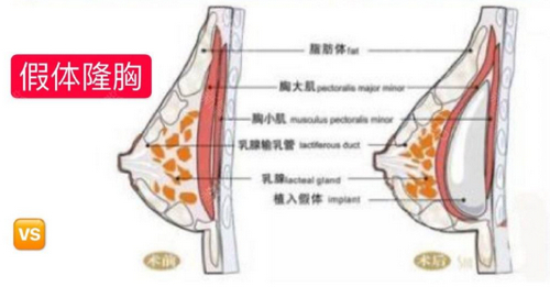 惠州元辰医疗美容整形医院胶原蛋白隆胸技术如何？看看网友分享的案例
