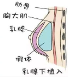 隆胸5.png