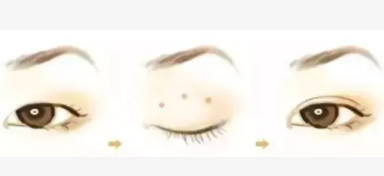 双眼皮9 (2).png