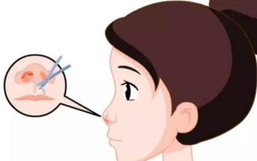 枝江诺美医疗美容诊所假体隆鼻多少钱？附案例分享