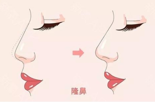 许昌市整形科假体隆鼻多少钱？口碑评价展示