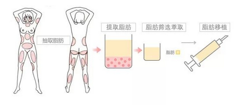 成都美立方医疗美容医院抽脂正规吗？医院信息+技术优势查看