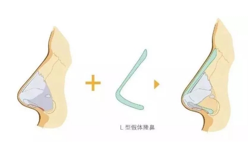 广东画美医疗美容整形医院隆鼻多少钱？哪个医生技术强