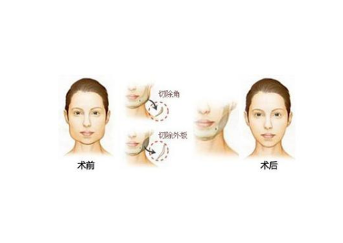 安徽医科大学第一附属医院整形美容中心颧骨整形好不好？给出机构简介及优势亮同步参考