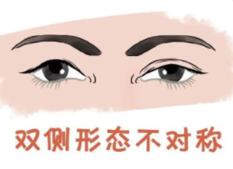 双眼皮14.png