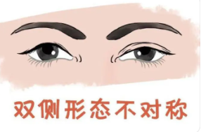 双眼皮5 (2).png