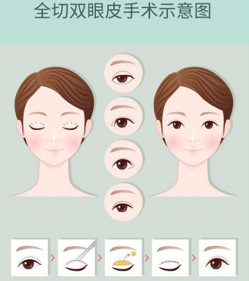 成都铜雀台做双眼皮技术怎么样？帮你优选医生&真实案例反馈i