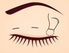 双眼皮17.png