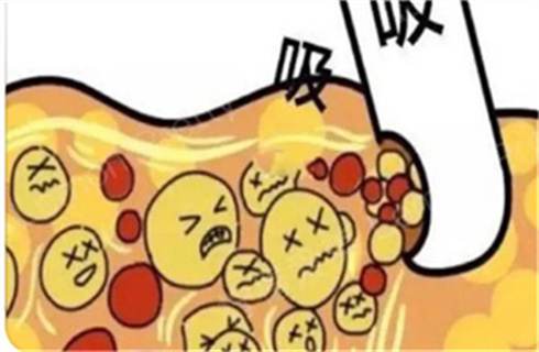 吸脂34.jpg
