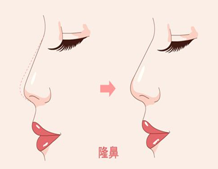 上海隆鼻价格多少钱？前五医院信息|在线实力测评